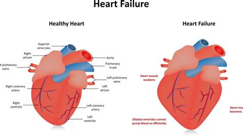 global hypokinesis of heart